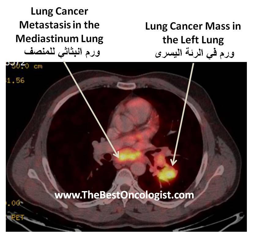 صورة طبقية نووية للرئتين تظهر ورم في الرئة اليسرى وورم انبثاثي للمنصف (المدياستنوم)