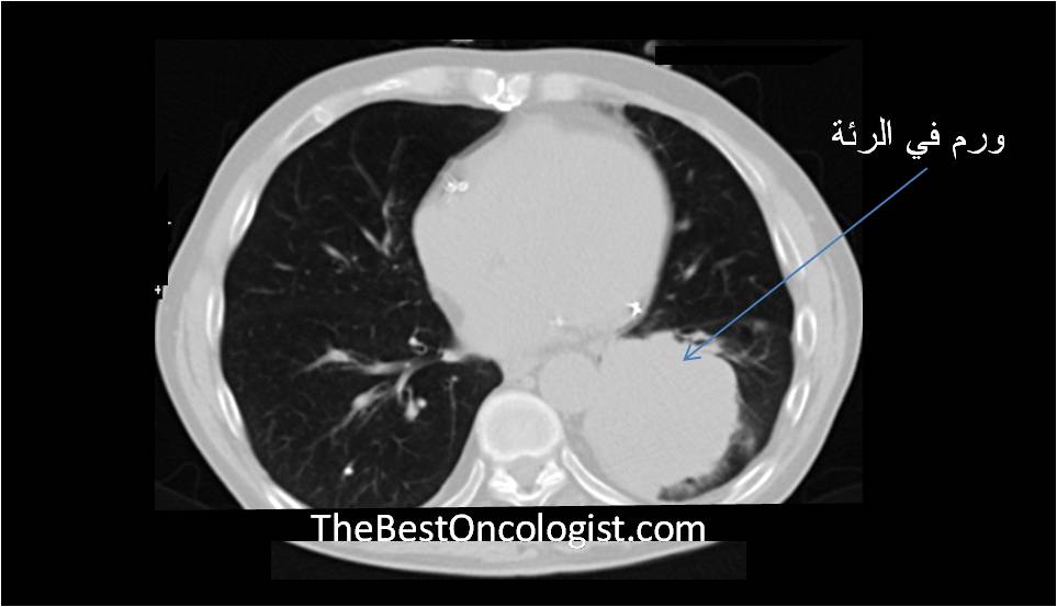 صورة طبقية لسرطان الرئة