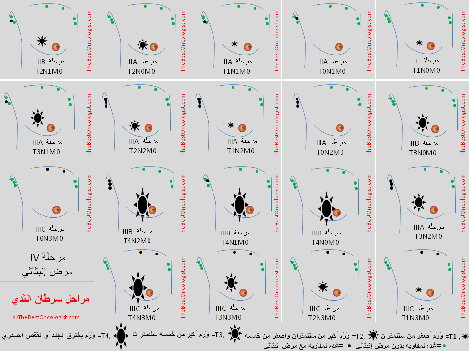 مراحل سرطان الثدي