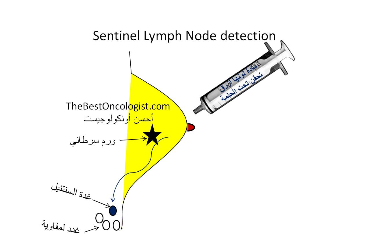 الجراحة لعلاج سرطان الثدي 