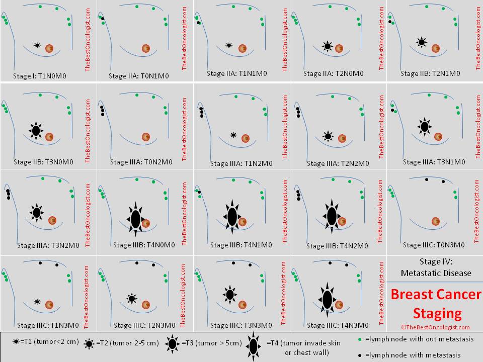 Breast Cancer Staging