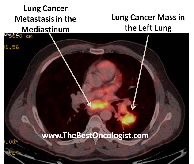 LUNG CANCER TUMOR in the LEFT LUNG WITH METASTASIS to the MEDIASTINUM