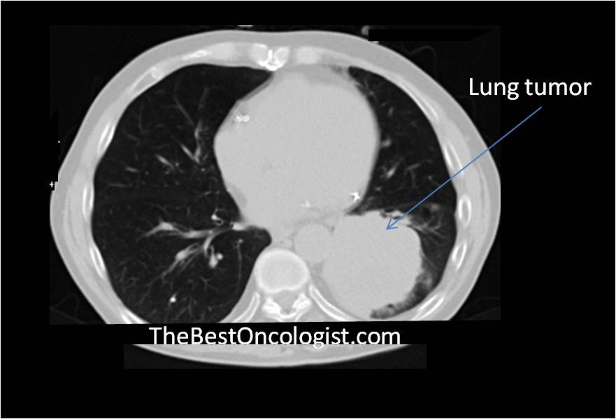 Lung Cancer CT