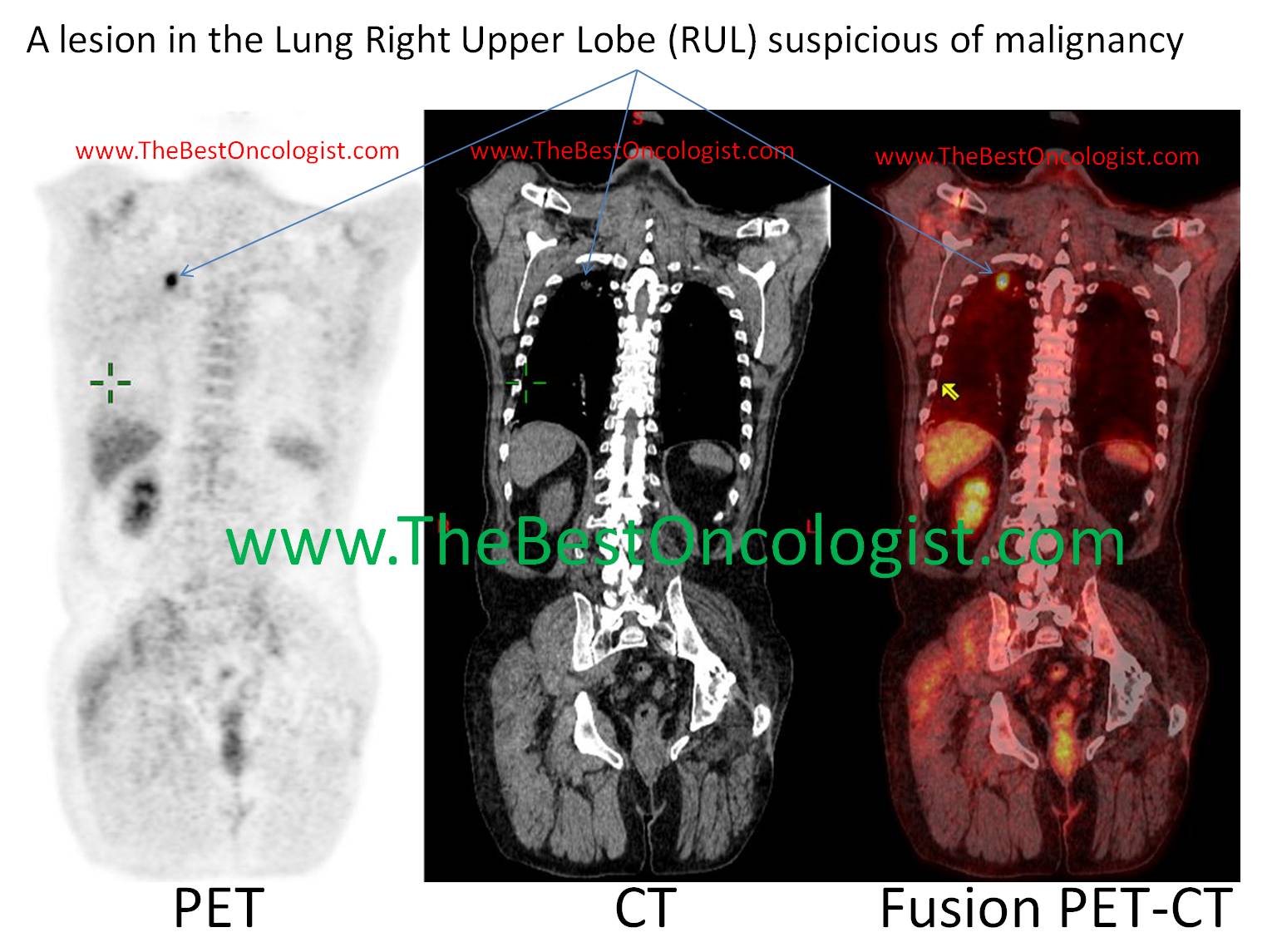 A lesion in the Lung Right Upper Lobe (RUL) suspicious of malignancy 